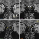 Brain scans of the women with a missing olfactory bulb but normal sense of smell (top right, bottom right), compared against a healthy control (top left) and a woman with a missing olfactory bulb and no sense of smell (bottom left)